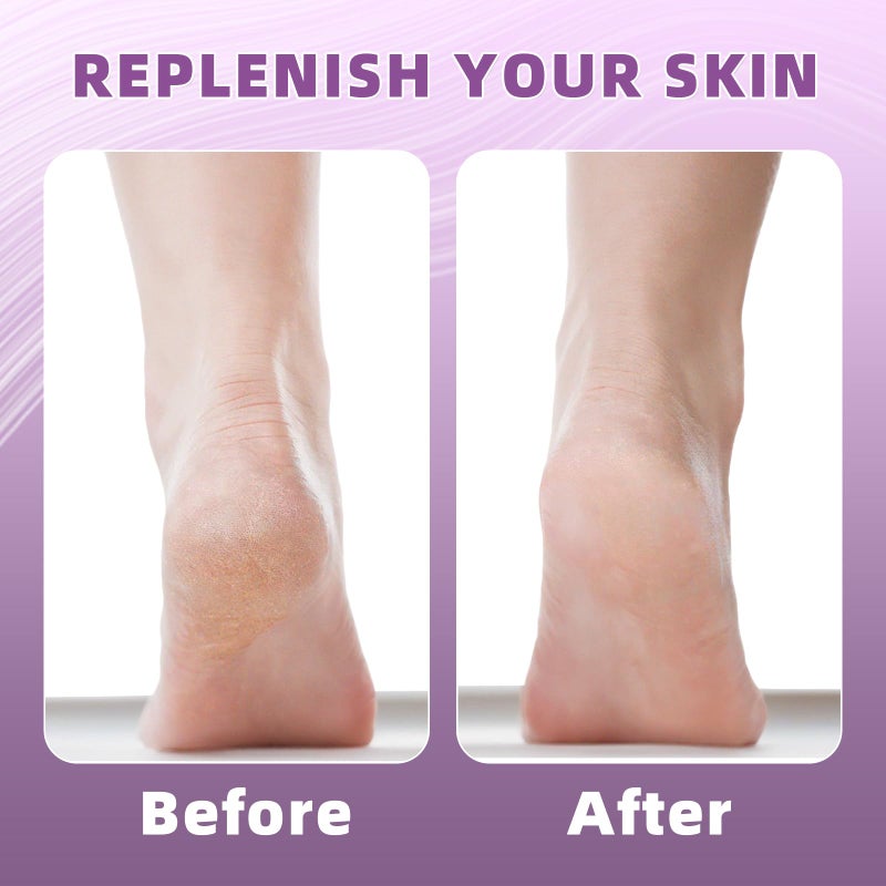 Untrytb 2 Pairs Silicone Socks for Dry Cracked Feet Women  Moisturizing Heel Socks  Gel Toeless Lotion Sock  Moisture Silicon Foot Sock for Cracked Heels Overnight by Untrytb - Image 5